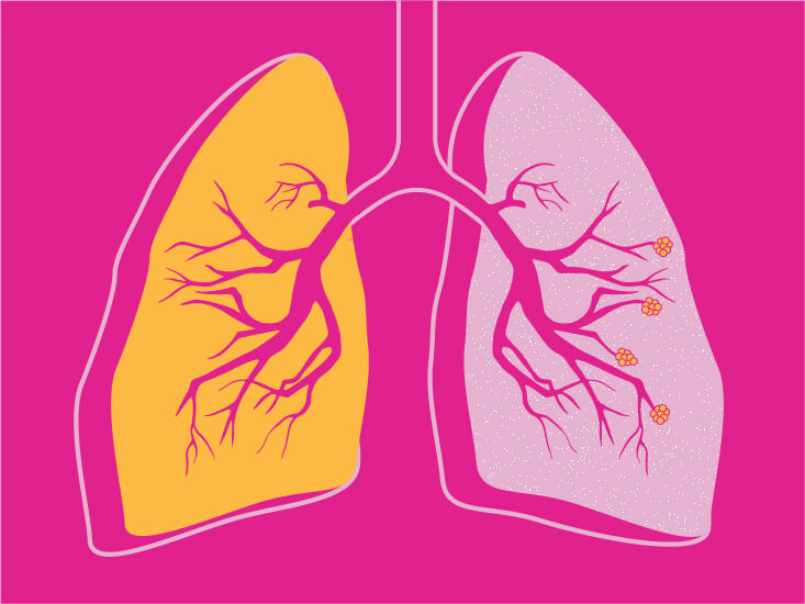 انسدد ریه یا COPD چیست